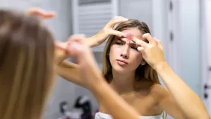 Remedios naturales para bajar la hinchazón del acné.