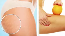 Estrías blancas y rojas: por qué salen y cuáles se pueden eliminar