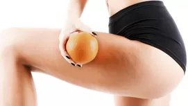 Estrías blancas y rojas: por qué salen y cuáles se pueden eliminar