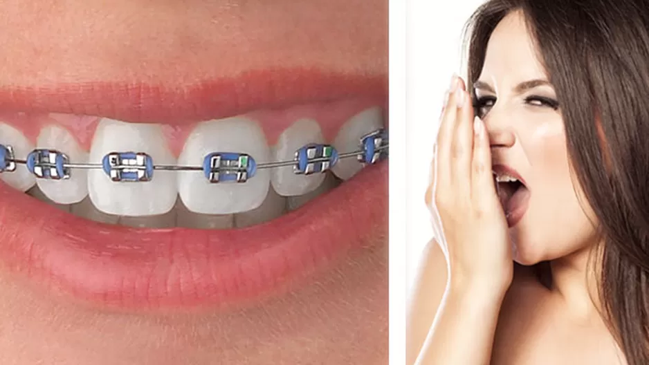 ¿Es normal tener mal aliento por los brackets?