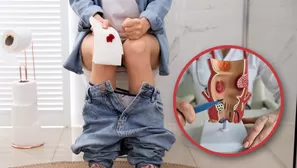 ¿Qué es bueno para curarse las hemorroides?