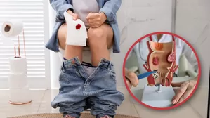 ¿Qué es bueno para curarse las hemorroides?