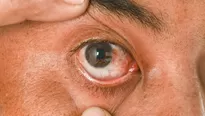 ¿Cuándo se debe operar la carnosidad en los ojos?