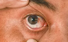 ¿Cómo es la operación que elimina la carnosidad en los ojos? - Noticias de operacion