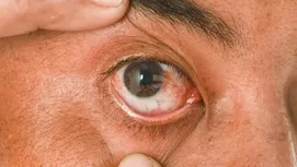 Carnosidad en los ojos: ¿Cómo empieza y cuáles son los síntomas?