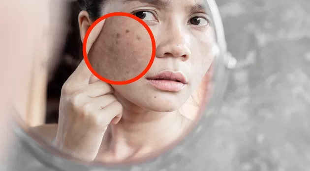 Tratamientos dermatológicos para quitar las manchas de la cara