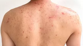 ¿Tienes estos granitos en los brazos? Así puedes eliminarlos