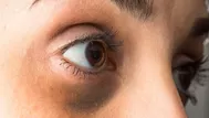 Tres tipos de ojeras y cómo debes tratarlas para ver resultados