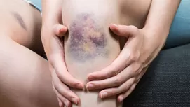 Bulto en la pierna u otra extremidad: ¿Cómo saber si es síntoma de cáncer?