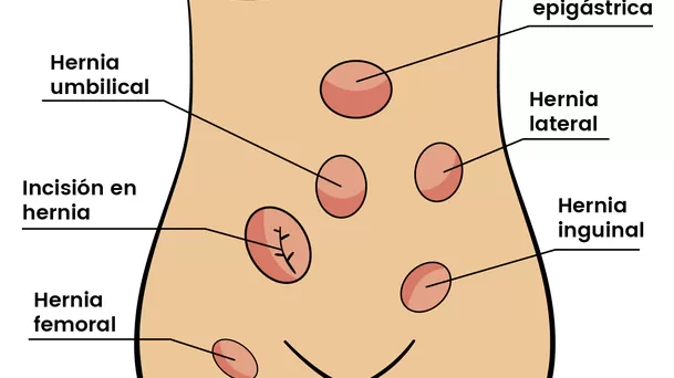 Tipos de hernias abdominales. (Foto: Hospital Fuensanta)