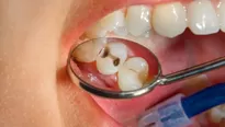 ¿Cómo prevenir las caries?