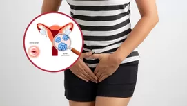 Cáncer de cuello uterino: causas y síntomas que debes conocer