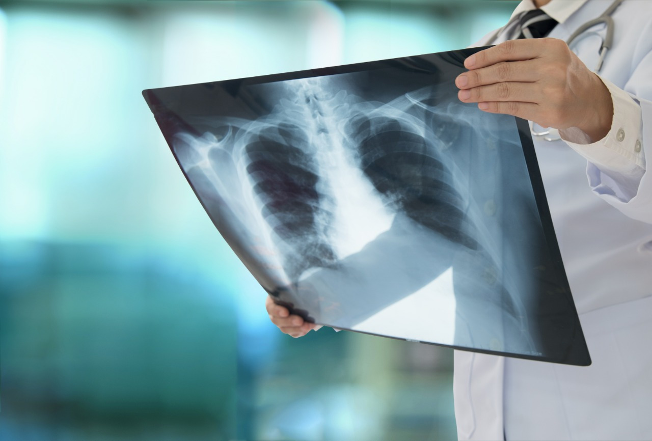 La radiografía permite evaluar si hay daño estructural del pulmón.