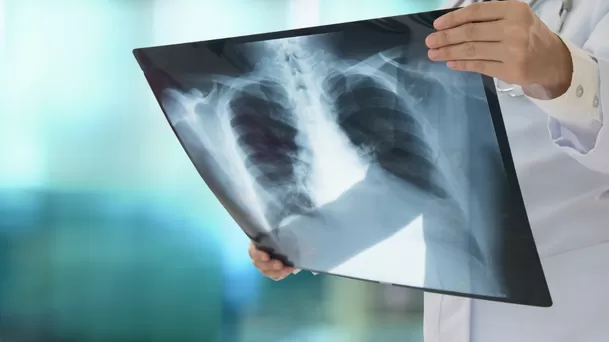 La radiografía permite evaluar si hay daño estructural del pulmón.