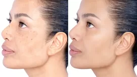 Seis remedios naturales que prometen quitar las manchas de la cara