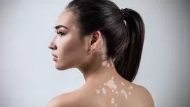 Psoriasis: causas y tratamiento de esta enfermedad en la piel