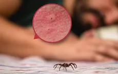 ¿Cuándo hay que preocuparse por una mordedura de araña? - Noticias de agua