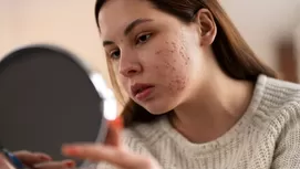 ¿Tienes estos granitos en los brazos? Así puedes eliminarlos