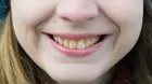 ¿Por qué a los niños les salen dientes amarillos?