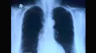 Placa de rayos X y tomografía: cuál es mejor para evaluar el pulmón