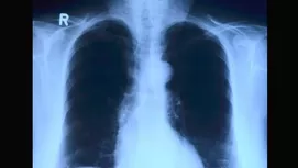 Los otros órganos que son afectados por fumar y que no sabías