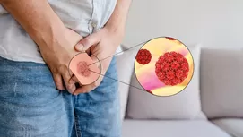 ¿Cómo saber si un hombre tiene el Virus del Papiloma Humano?