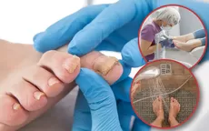 ¿Dónde hay mayor riesgo de contraer hongos en las uñas y los pies? - Noticias de Gerard Piqué