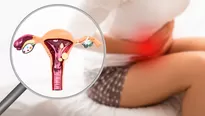 ¿Cuáles son los síntomas de la endometriosis?