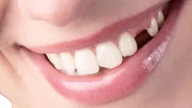 ¿Cómo evitar los dientes chuecos y una mala mordida en tus hijos?