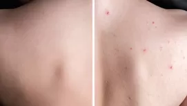 ¿Tienes estos granitos en los brazos? Así puedes eliminarlos