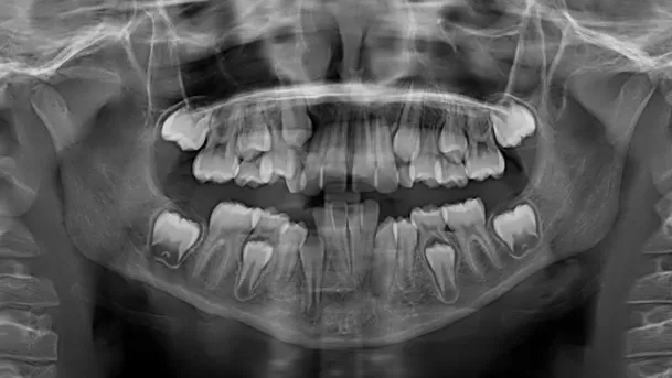 Paciente de 8 años y 7 meses que muestra una dentición mixta con dientes de leche y permanentes. (Foto: Dra. Karen Romero) Paciente de 8 años y 7 meses que muestra una dentición mixta con dientes de leche y permanentes. (Foto: Dra. Karen Romero)