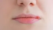 ¿Cuáles son las causas del herpes labial?