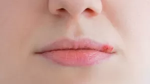 ¿Cuáles son las causas del herpes labial?