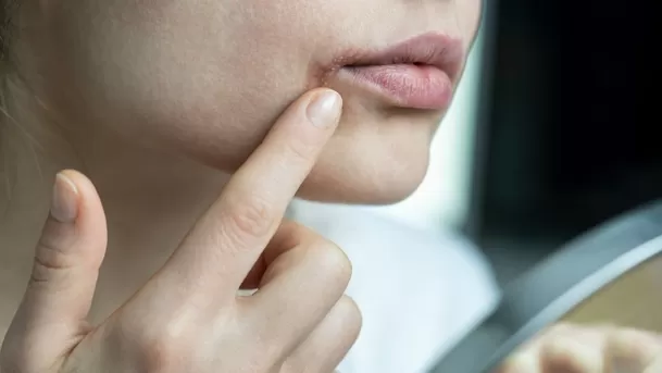 Uno de los desencadenantes del herpes labial es el estrés. 