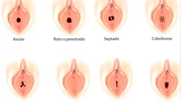 Tipos de himen. (Foto: Dra. Alejandra Andrino)
