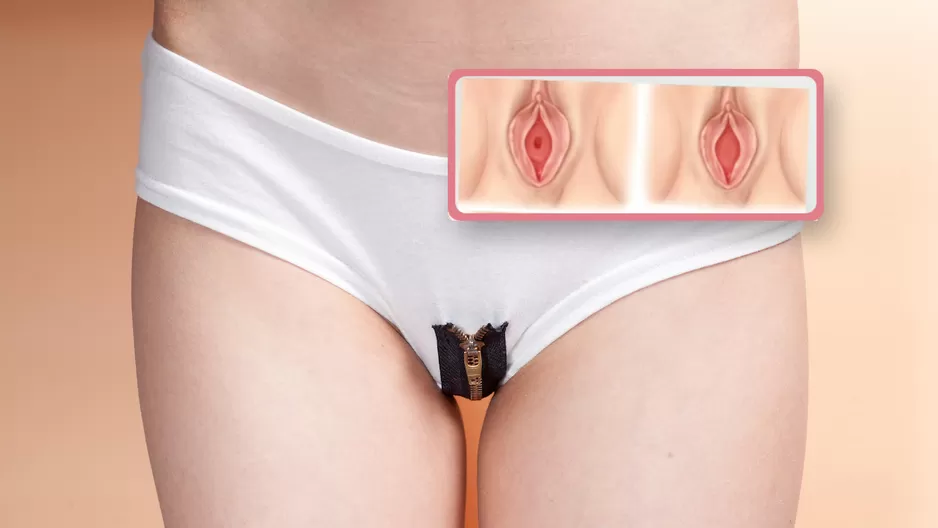 ¿Qué pasa con el himen luego de romperse? 