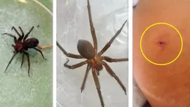 ¿Qué es lo primero que debes hacer si sufres una quemadura?