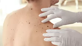 Cáncer de piel: ¿dónde aparecen lunares cancerígenos y cómo detectarlos?