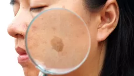 Seis remedios naturales que prometen quitar las manchas de la cara