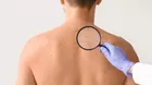 ¿Las manchas en las espalda pueden ser una señal de enfermedad?