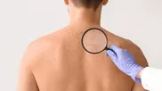 ¿Por qué aparecen manchas oscuras en la espalda?