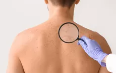 ¿Las manchas en las espalda pueden ser una señal de enfermedad? - Noticias de enfermedad