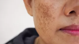 Mascarillas naturales que prometen aclarar la piel de tu rostro