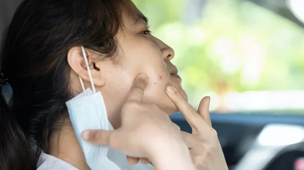 La fricción de la mascarilla acentúa los brotes de acné