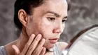 Melasma: ¿por qué salen estas manchas en la cara?