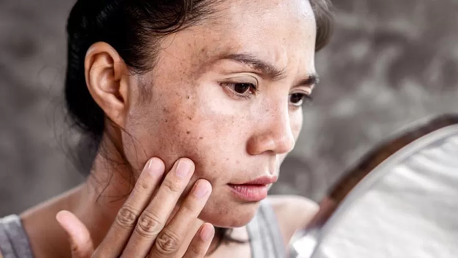 Cuatro datos que no sabías sobre el melasma (Foto: Aquamed)