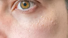 ¿Por qué tienes el rostro grasoso y cómo evitarlo?