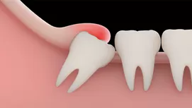Descubre cómo se puede curar las caries sin dolor