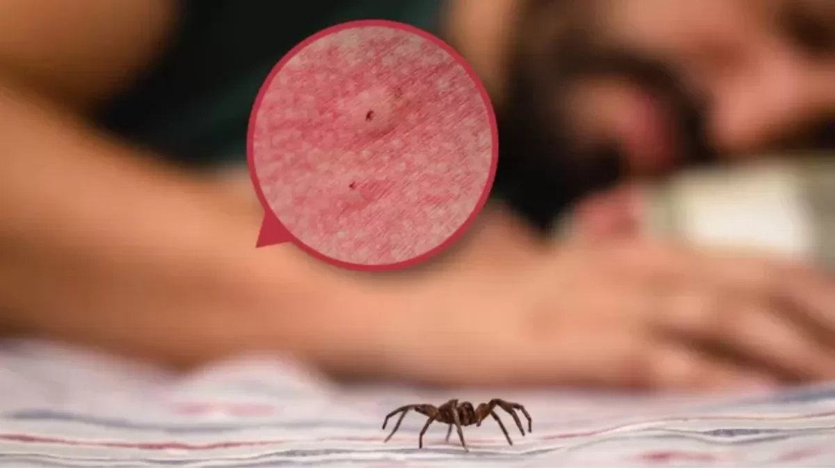 La picadura de una araña puede generar un dolor intenso, seguido de una inflamación.