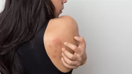 Psoriasis: causas y tratamiento de esta enfermedad en la piel